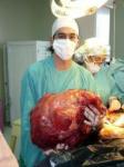 Doctors Remove The World's Largest Tumor